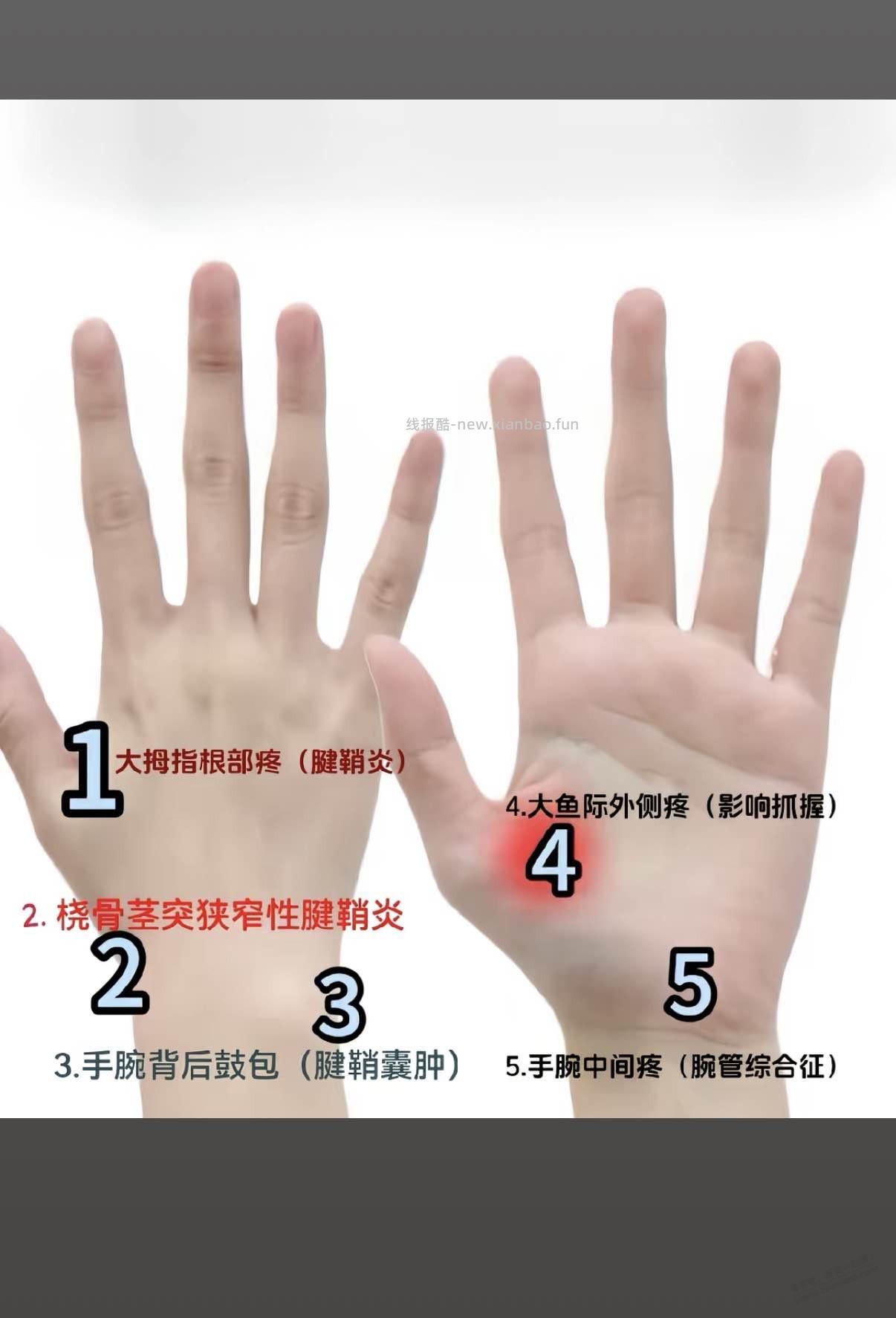 手拇指腱鞘炎，有啥偏方么？ - 线报酷