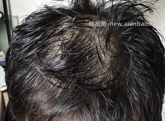 日记：唉，秃头了，附照片（不喜勿进） - 线报酷