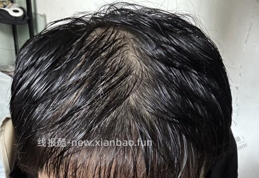 日记：唉，秃头了，附照片（不喜勿进） - 线报酷