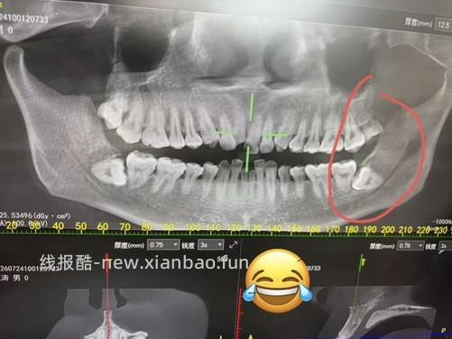 拔牙后几天真难熬 阻生智齿 帮助大家下次搜索有数据 - 线报酷